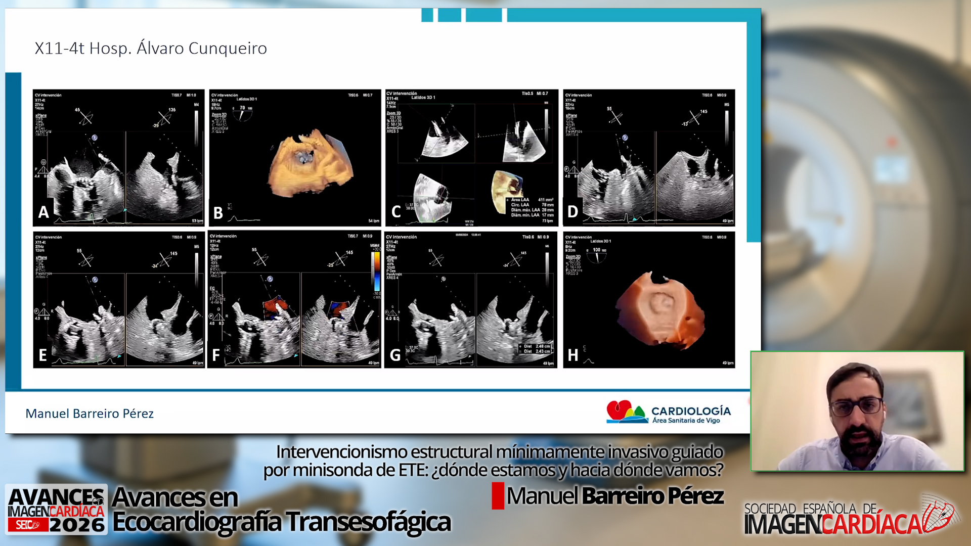 Intervencionismo estructural mínimamente invasivo guiado por minisonda de ETE: ¿dónde estamos y hacia dónde vamos?