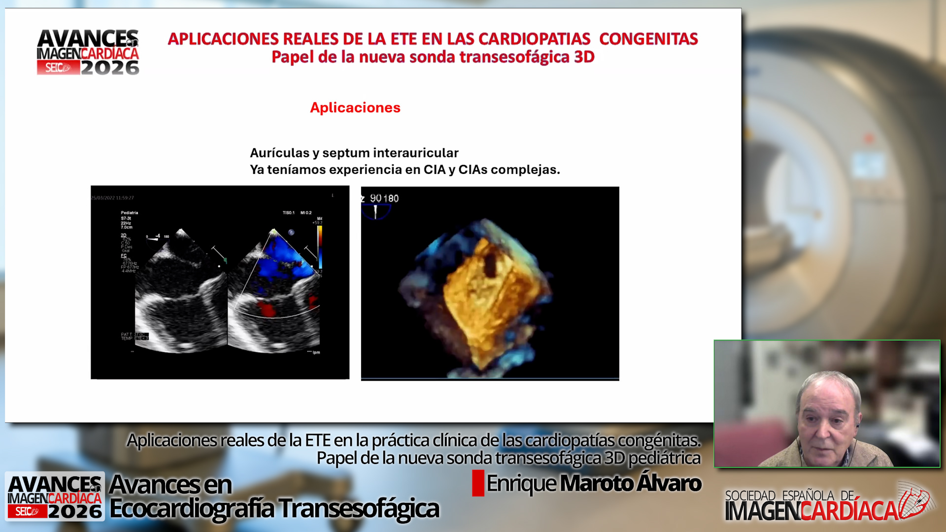 Intervencionismo estructural mínimamente invasivo guiado por minisonda de ETE: ¿dónde estamos y hacia dónde vamos? (2)