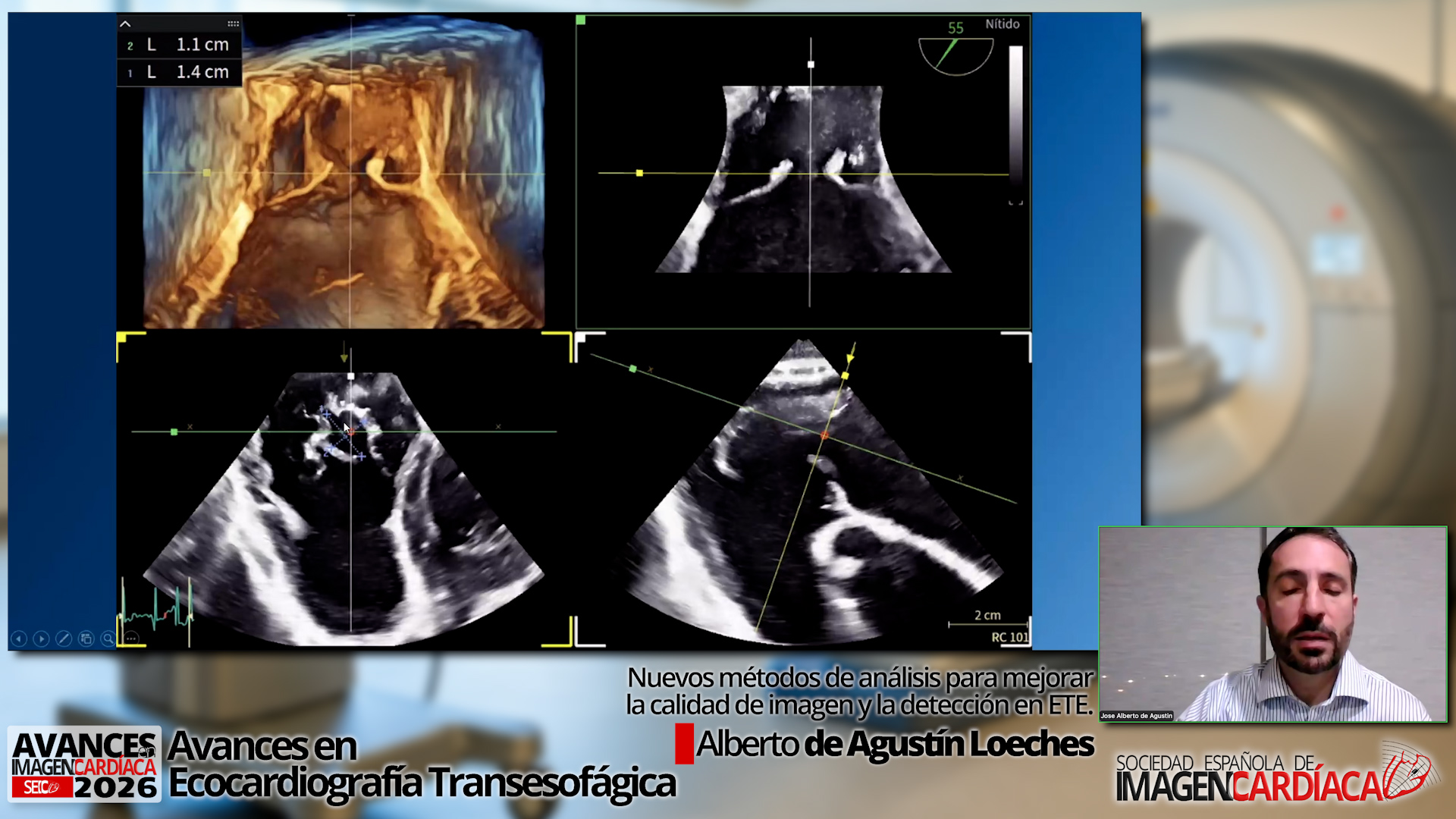 Nuevos métodos de análisis para mejorar la calidad de imagen y la detección en ETE