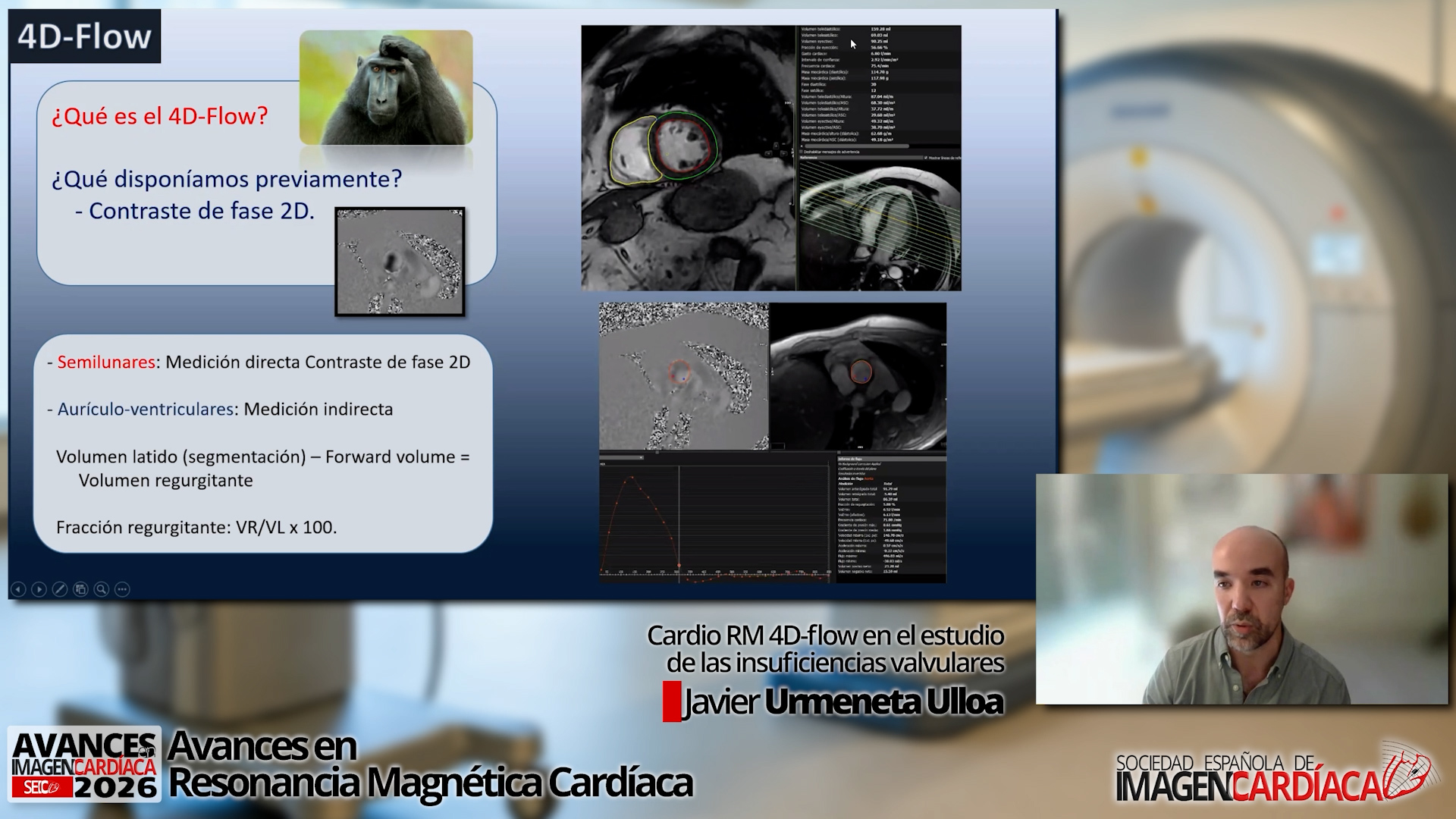 Cardio RM 4D-flow en el estudio de las insuficiencias valvulares