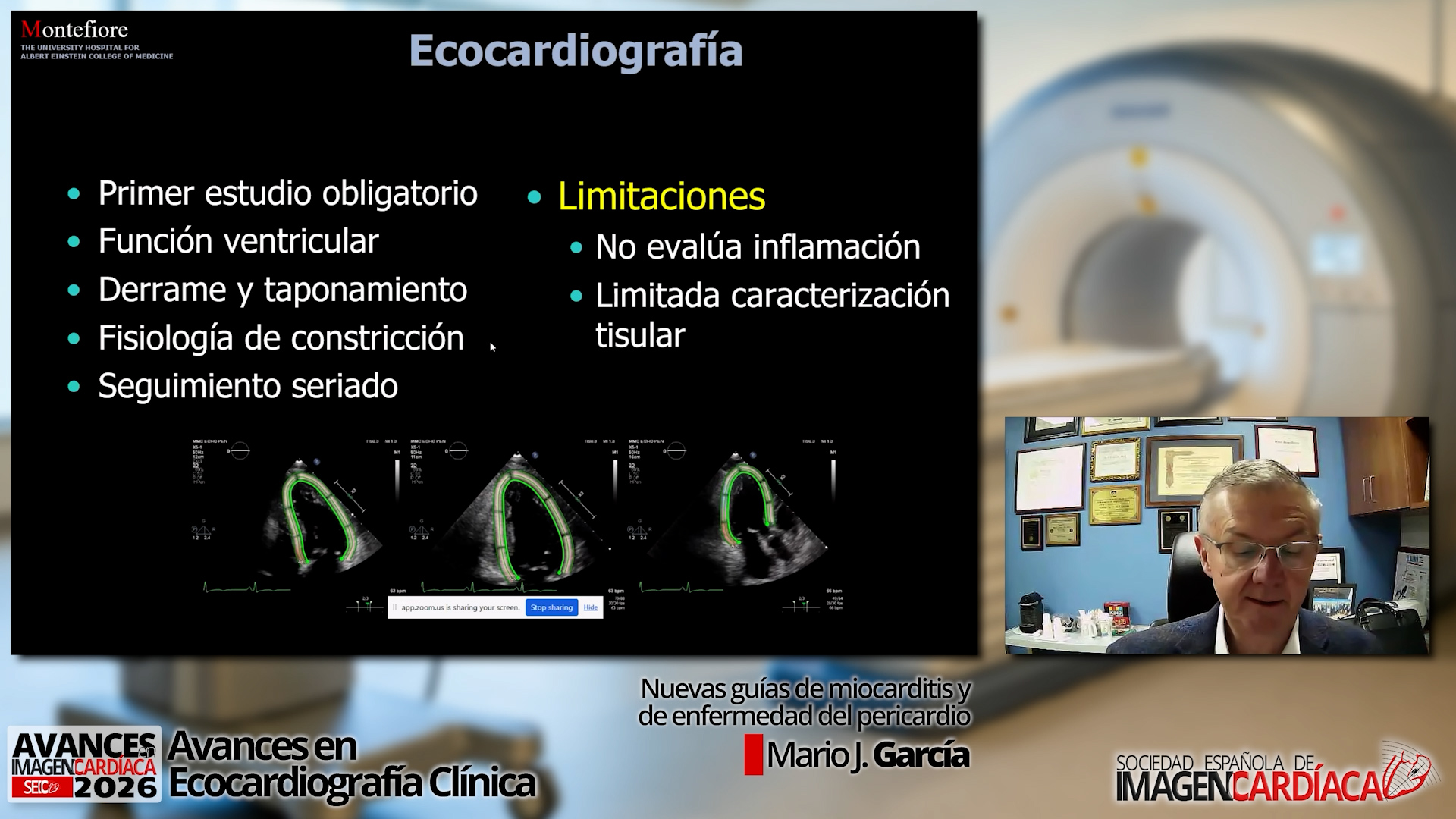 Nuevas guías de miocarditis y de enfermedad del pericardio
