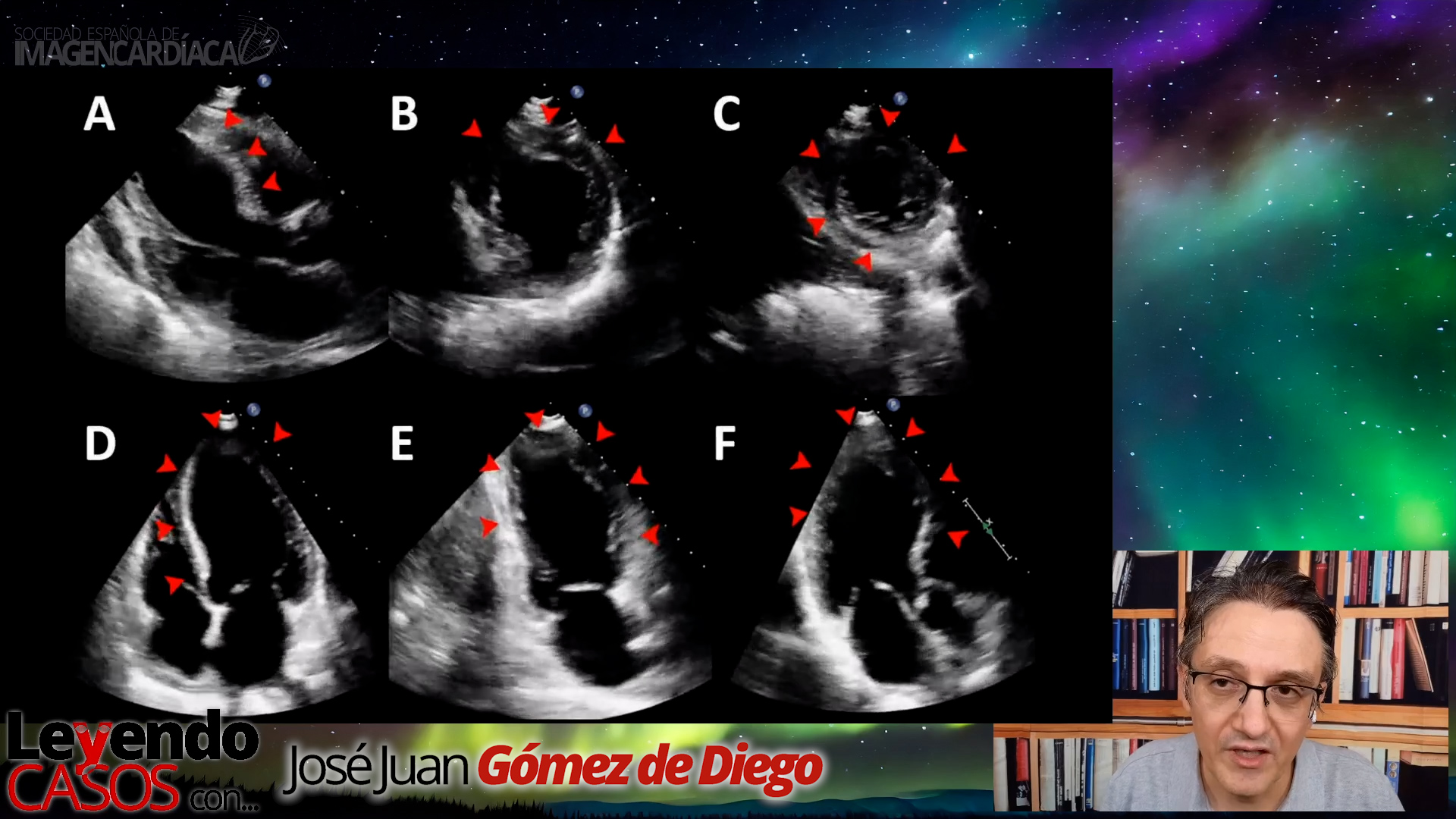 José Juan Gómez de Diego - Complicaciones del Infarto de Miocardio (1)