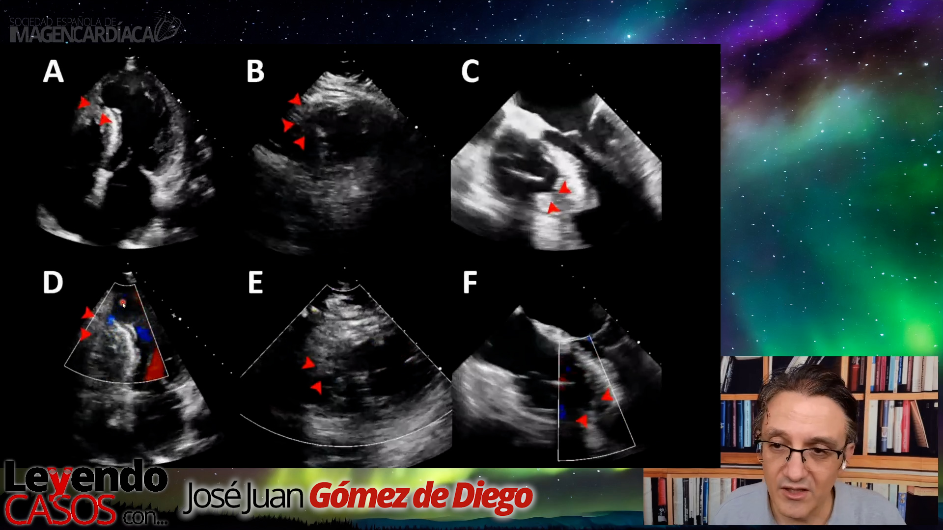 José Juan Gómez de Diego - Complicaciones del Infarto de Miocardio (2)