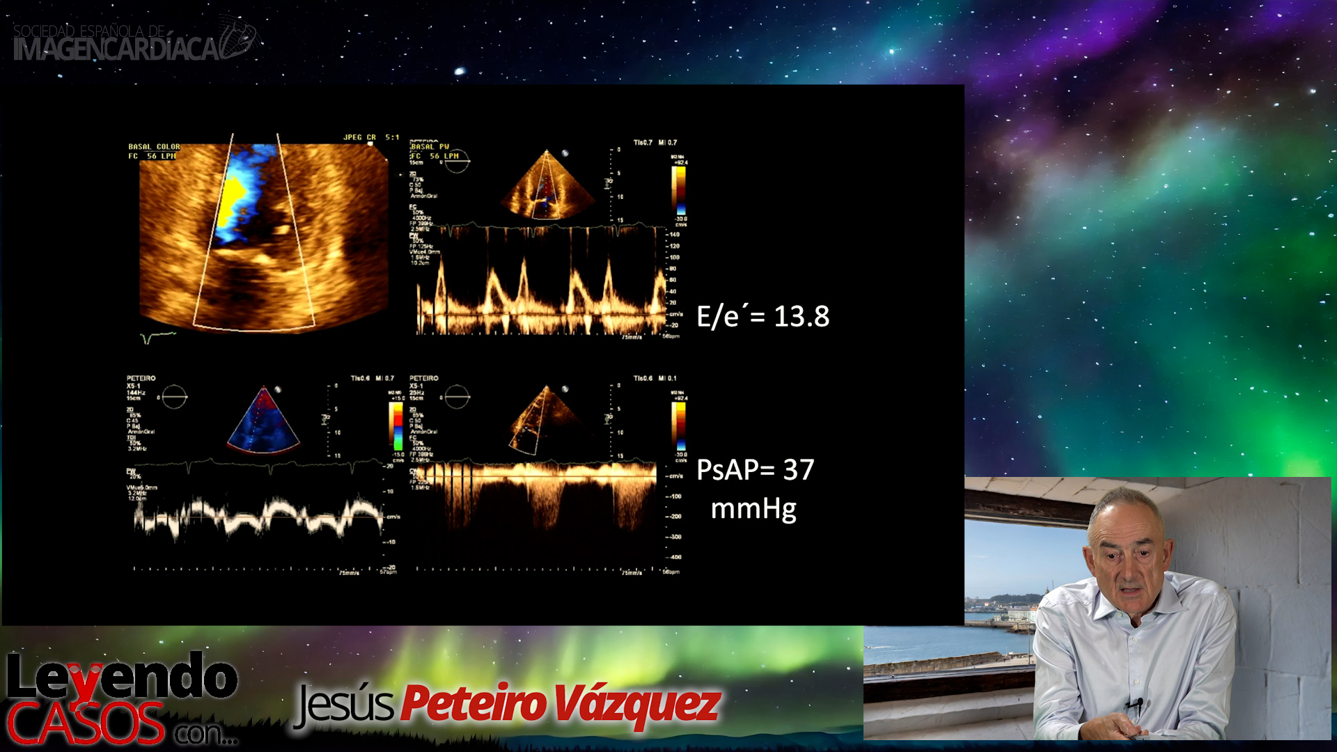 Jesús Peteiro - Casos de Eco de Estrés (1)