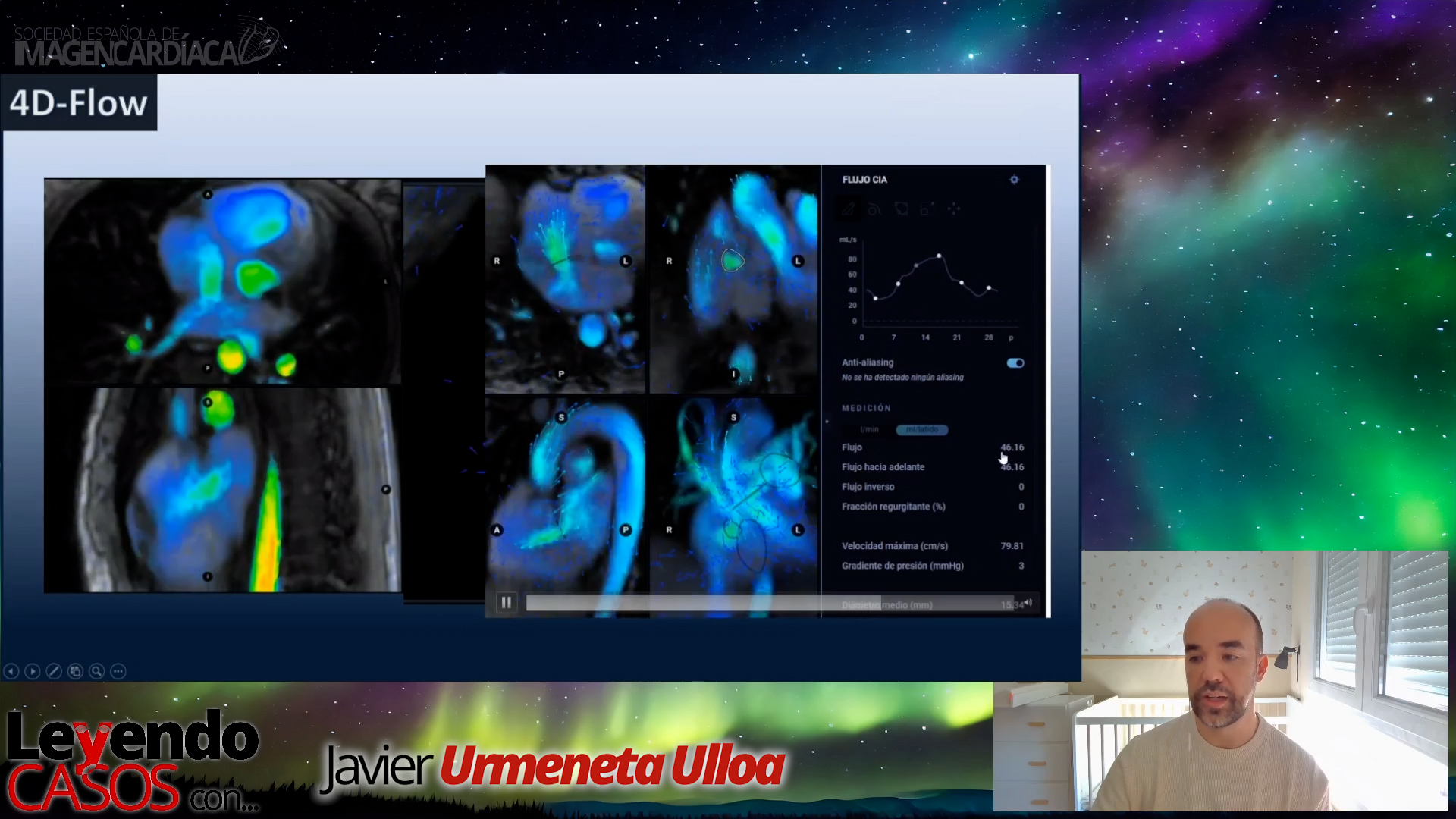 Javier Urmeneta - 4D Flow en Pacientes con Shunts Cardíacos