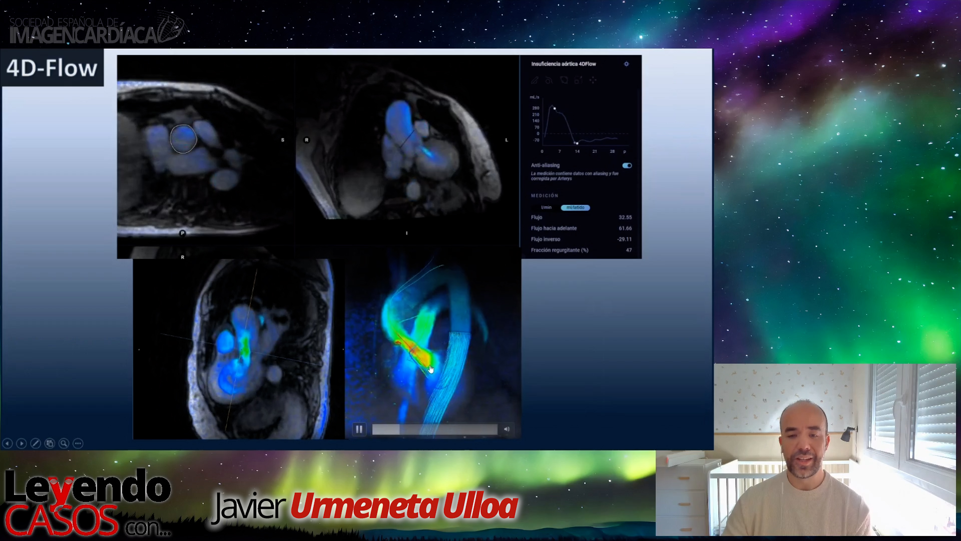 Javier Urmeneta - 4D Flow en Pacientes con Valvulopatías