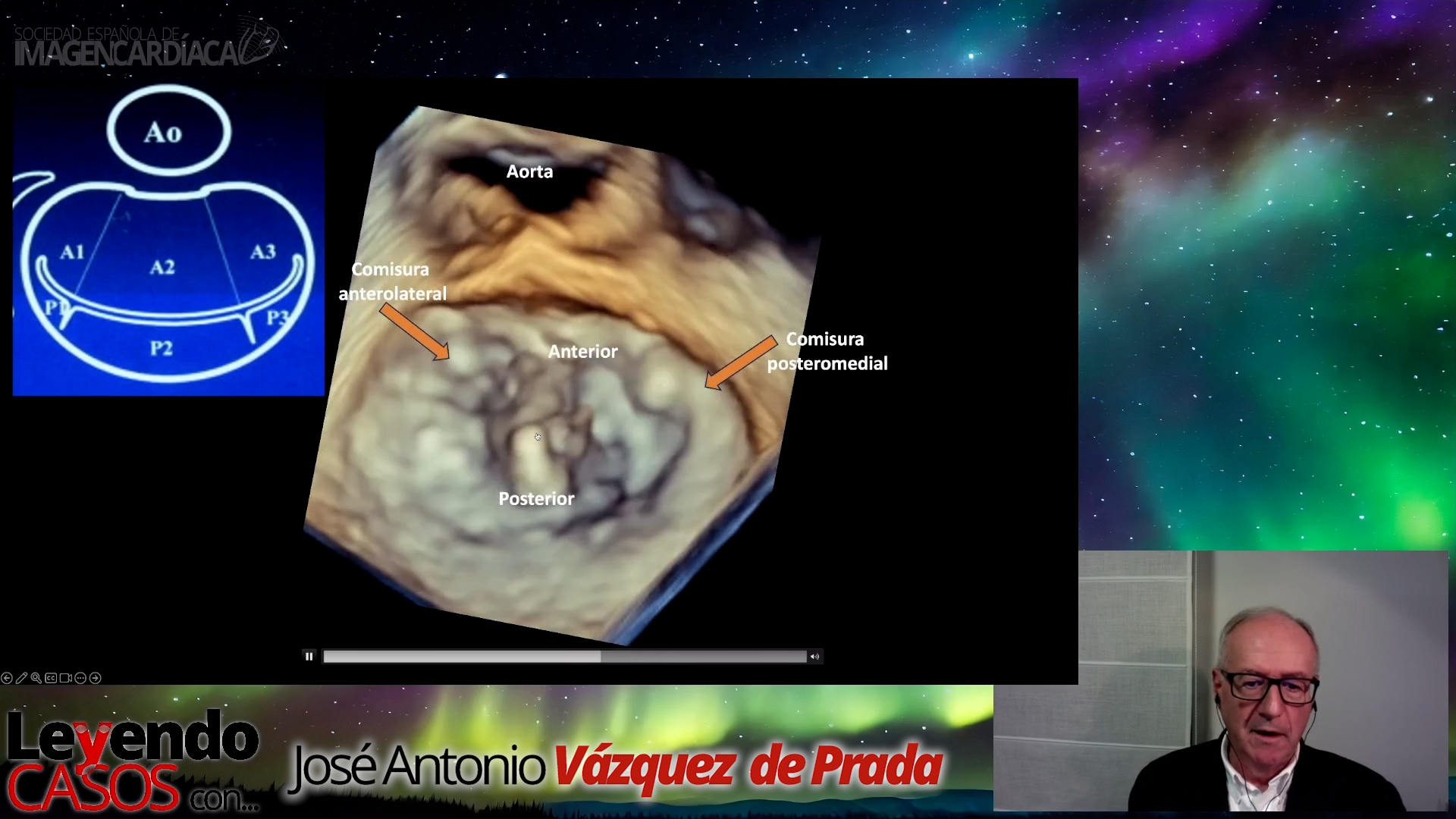 José Antonio Vázquez de Prada - Casos de Eco 3D en Patología Mitral