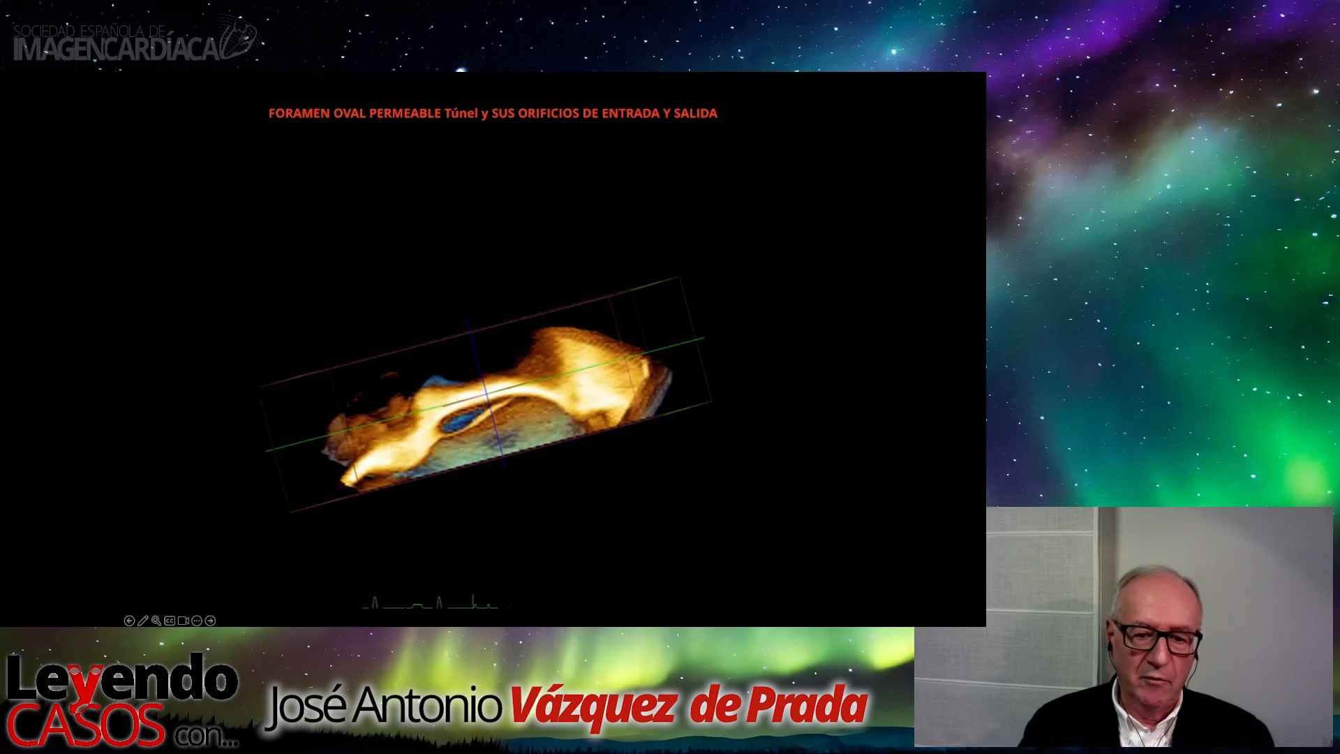 José Antonio Vázquez de Prada - Casos de Eco 3D Foramen Ovale Permeable