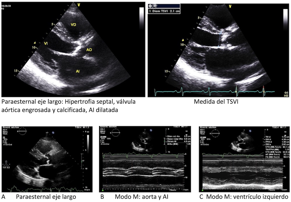Figura 1: Ecocardiograma de paciente con estenosis aórtica, plano paraesternal, medida del TSVI y Modo M