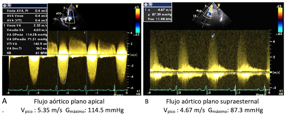 Figura 2: Doppler del flujo aórtico en el mismo paciente, desde diferentes ventanas: apical y supraesternal