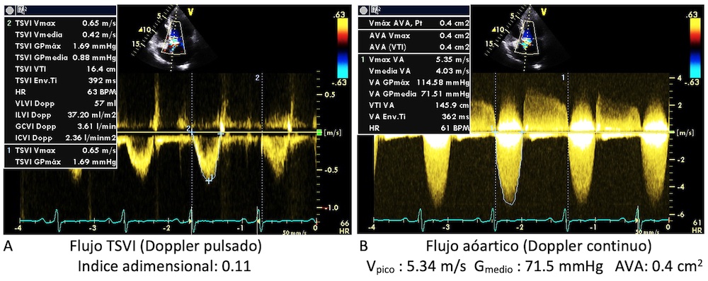 Figura 4: Estudio Doppler en EA para valorar velocidad, gradiente y área valvular aórtica