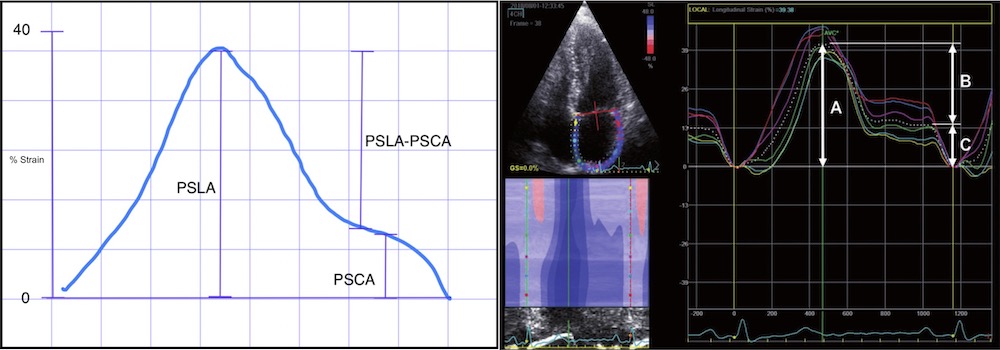 Figura 2. Representación las distintas fases de la curva de deformación auricular, donde PSCA= pico de strain (deformación) de la contracción auricular, PSLA = Pico de strain (deformación) longitudinal auricular y en el recuadro de la derecha un estudio tipo en visión de 4 cámaras.