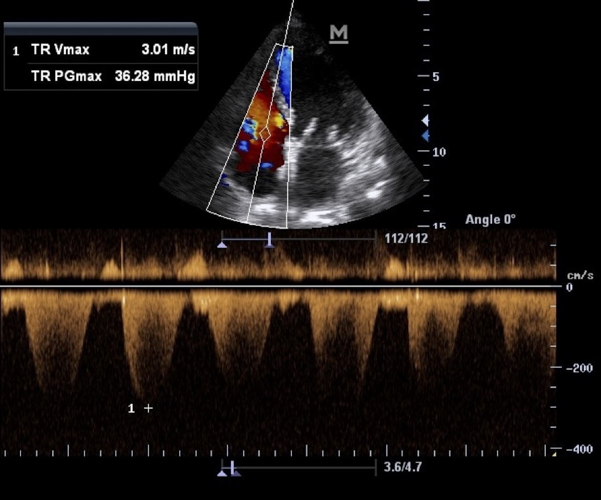 Figura 2. Ventana apical de 4 cámaras. Estimación de la presión sistólica de la arteria pulmonar, se alinea el cursor del Doppler continuo con el jet de regurgitación tricúspide y a partir de la ecuación simplificada de Bernoulli se estima el gradiente (gradiente de presión= 4 x Velocidad²). En la imagen se observa una velocidad pico de regurgitación de 3,01 m/s, lo que corresponde a un gradiente de 36,28mmHg entre el VD y la AD.