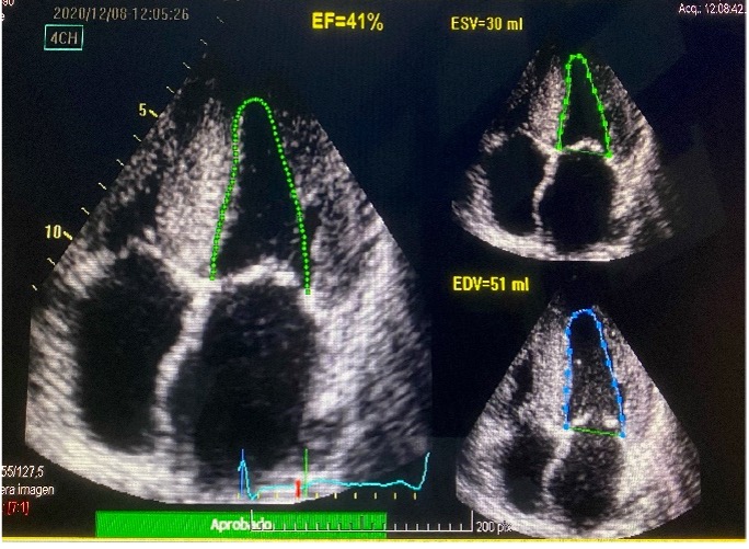 Figura 2.- Imagen obtenida al mismo paciente con amiloidosis cardiaca y el estudio realizado por el mismo médico con un método distinto, fracción eyección automática 41%.