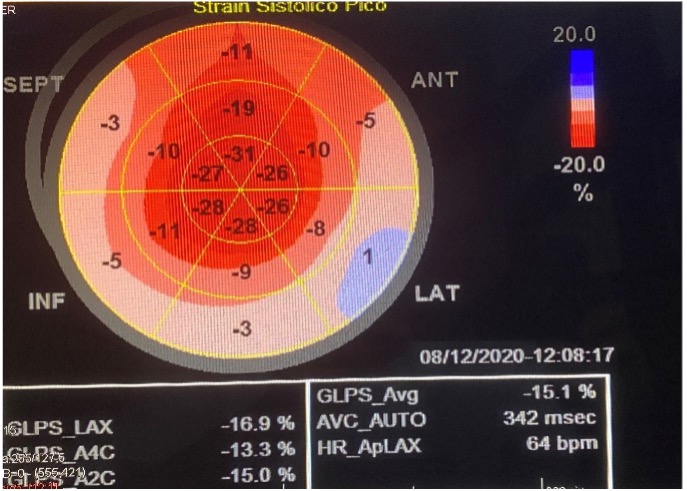 Figura 3.- Imagen del paciente anterior con amiloidosis cardiaca, strain sistólico pico, característica bandera Japón, resultado strain -15.1 %