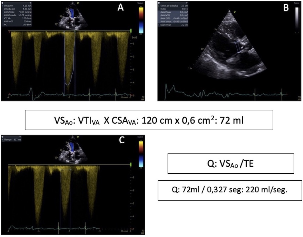 Figura 4. Cálculo del flujo transvalvular aórtico; se estima el volumen sistólico del ventrículo izquierdo mediante la fórmula VS: VTIVA x CSAVA calculando la fórmula de continuidad (ver figuras 1 y 2) A y B, y este se divide con el tiempo eyectivo sistólico aórtico (TE) tal como se ha medido en este caso en C. (cortesía Dra. R. Olarte, ecocardiografísta Hospital Militar Central de Bogotá).