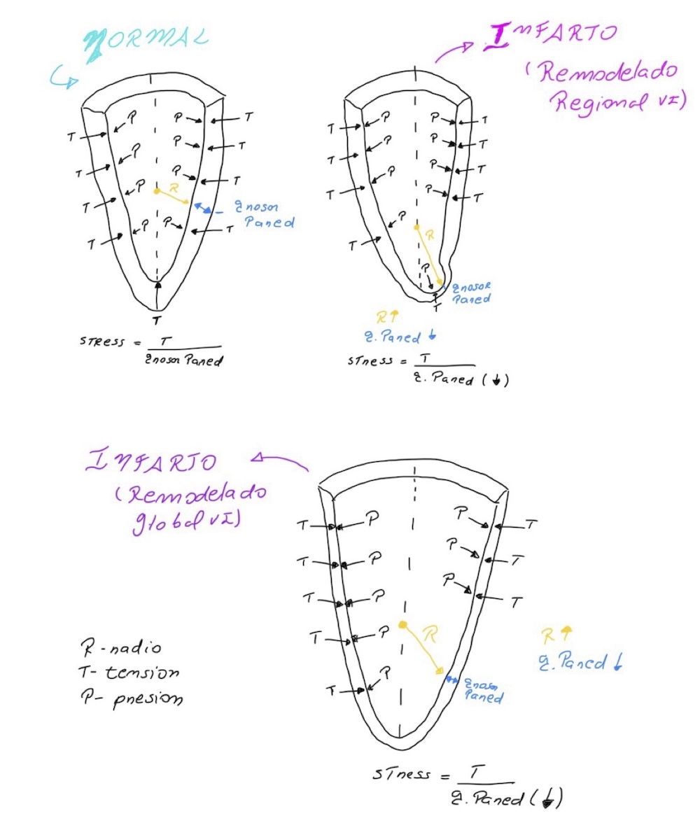 Figura 3. Stress de la pared en un corazón normal, es proporcional a la tensión e inversamente al grosor de la pared. En el infarto de miocardio con remodelado regional, el stress regional esta incrementado por el adelgazamiento de la pared e incremento del radio. Cuando el ventrículo se dilata globalmente, el stress global aumenta por el incremento del radio principalmente y en menor grado por el adelgazamiento de la pared.