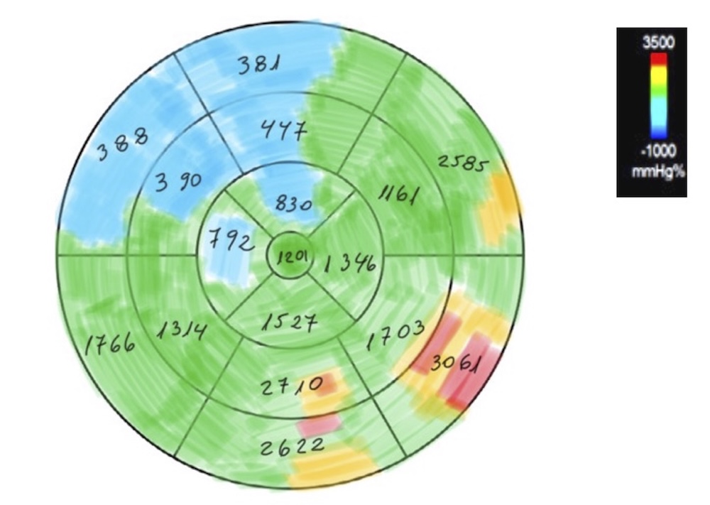 Figura 7. Bull’s eye del trabajo miocárdico (17 segmentos): área de trabajo negativo en azul, valores normales en verde, área de trabajo elevado en rojo.