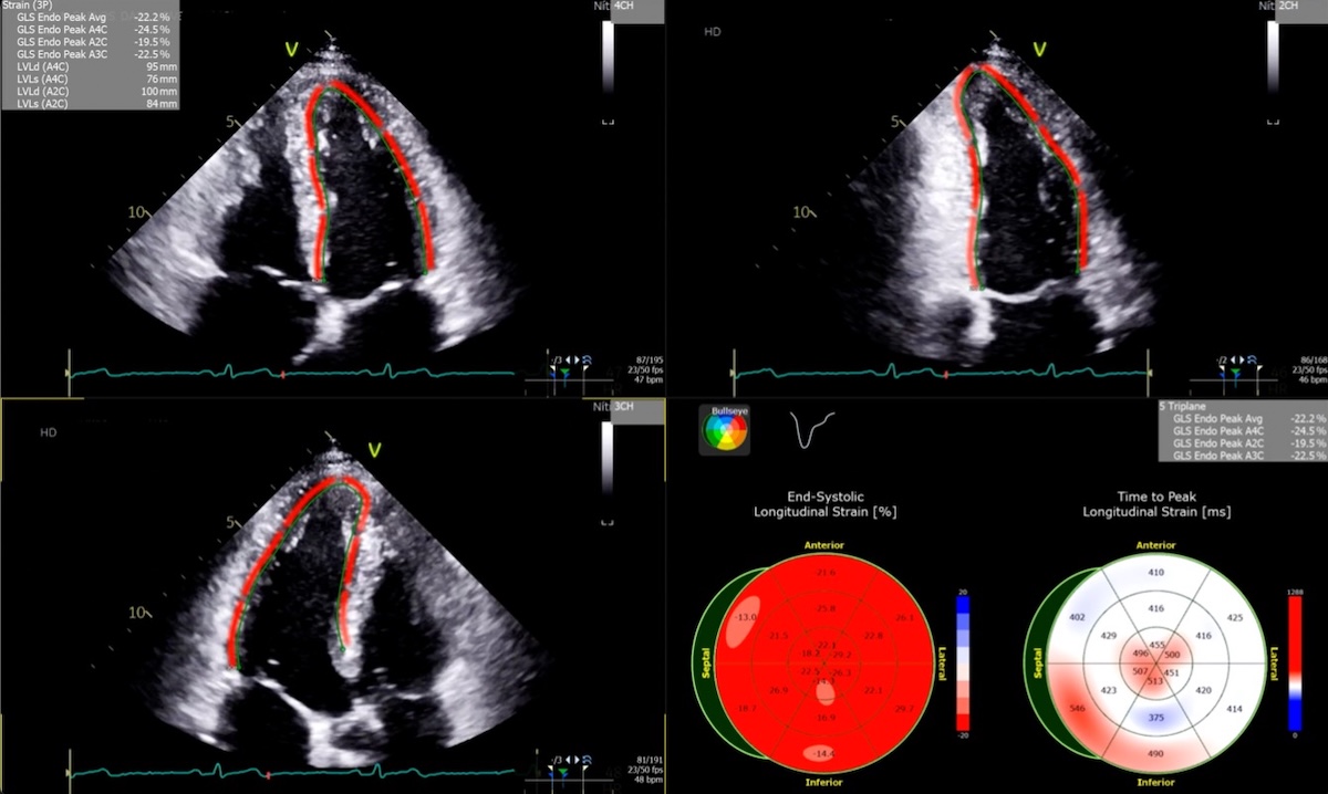 Figura 1. Ventanas ecocardiográficas a la cabecera del paciente con medición de GLS normal con representación en ojo de buey y valores absolutos negativos en el rango de normalidad. Imágenes tomadas en servicio de ecocardiografía ambulatoria de la clínica valle del Lili, autoría de alumna Nela Melissa Parra Landázury.