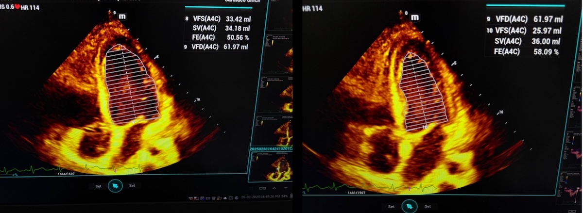 Figura 3b: Ventanas ecocardiográficas a la cabecera del paciente para estimar el acoplamiento ventrículo arterial. Imágenes tomadas en sala de reanimación fundación valle del Lili, autoría de alumna María Camila Zuluaga Sánchez. Figura 3b: Ventanas ecocardiográficas a la cabecera del paciente para estimar el acoplamiento ventrículo arterial. Imágenes tomadas en sala de reanimación fundación valle del Lili, autoría de alumna María Camila Zuluaga Sánchez.