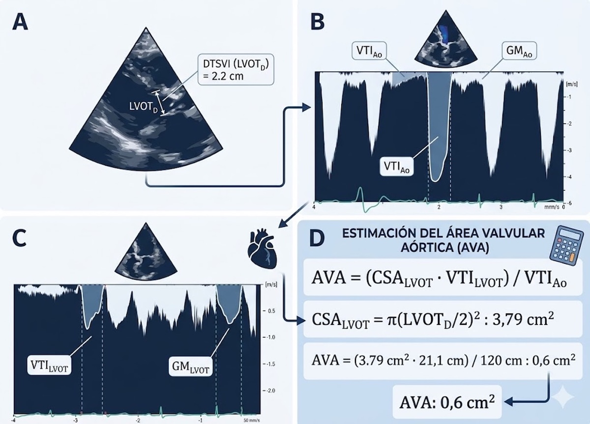 Ecuación de continuidad para el cálculo del Área Valvular Aórtica. (Elaboración propia).
