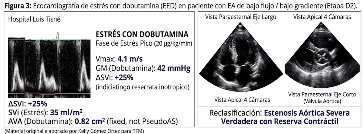 Ecocardiografía de estrés con dobutamina (EED) en paciente con EA de bajo flujo / bajo gradiente (Etapa D2).