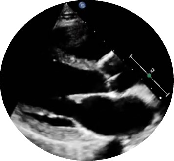 Figura 4. Medición de diámetro anillo mitral antero-posterior en eje paraesternal largo en mesodiástole.