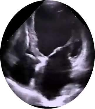 Figura 5. Medición de diámetro anillo mitral lateral-medial en eje apical 4 cámaras en telediástole.