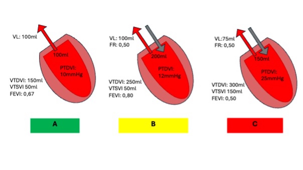 Figura 3. Hemodinámica del VI en la insuficiencia aórtica. A. Condiciones normales. B. Insuficiencia aórtica severa crónica compensada. C. Insuficiencia aórtica crónica descompensada Figura 3. Hemodinámica del VI en la insuficiencia aórtica. A. Condiciones normales. B. Insuficiencia aórtica severa crónica compensada. C. Insuficiencia aórtica crónica descompensada