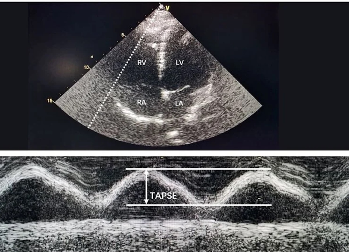 Imagen 1. Evaluación ecocardiográfica del ventrículo derecho. En la vista apical de cuatro cámaras es posible valorar el tamaño del ventrículo derecho y estimar su función sistólica mediante parámetros como el TAPSE, que mide la excursión longitudinal del anillo tricuspídeo.