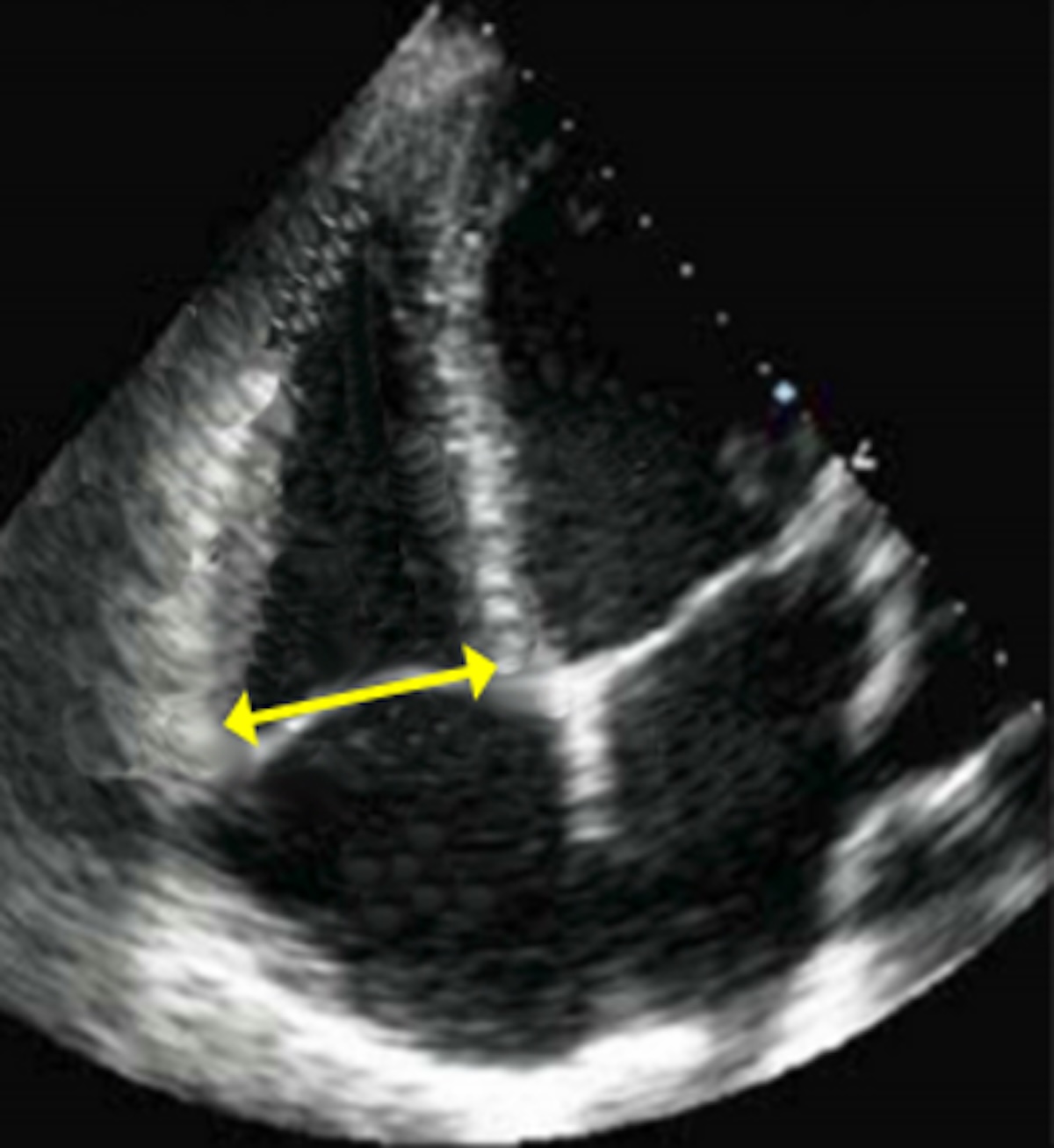Imagen 2. Plano apical 4 cámaras con medición del diámetro basal del VD