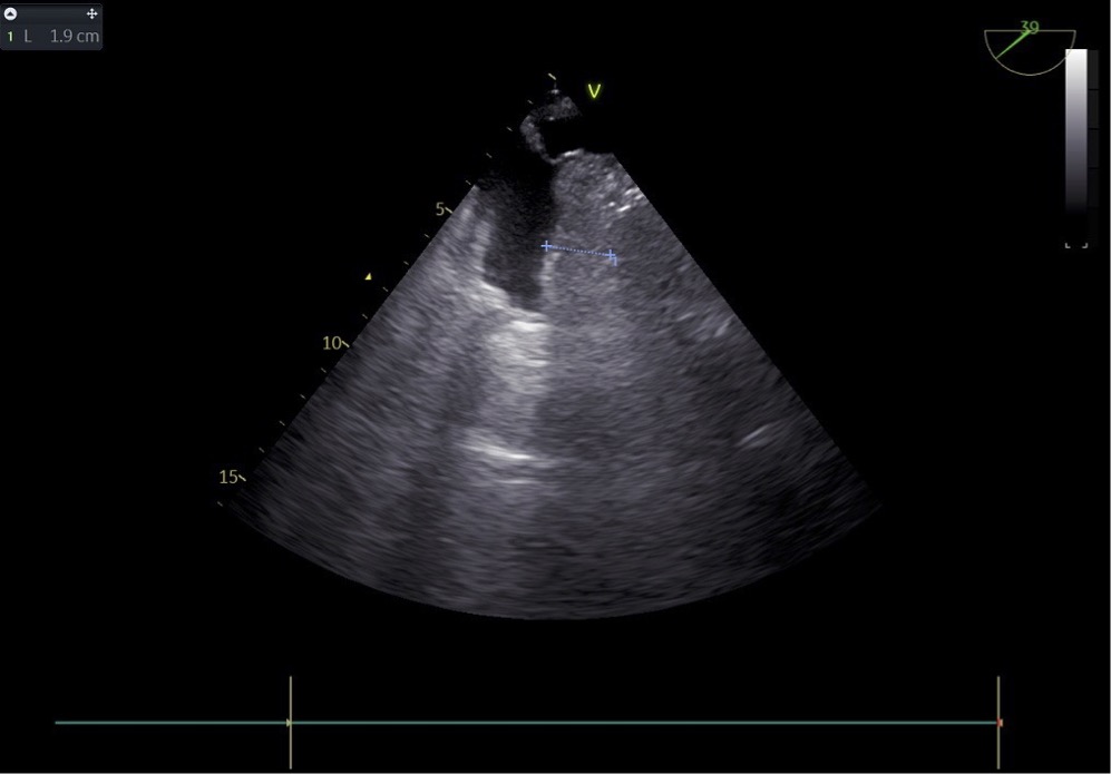 Figura 2. Hematoma aurícula derecha.