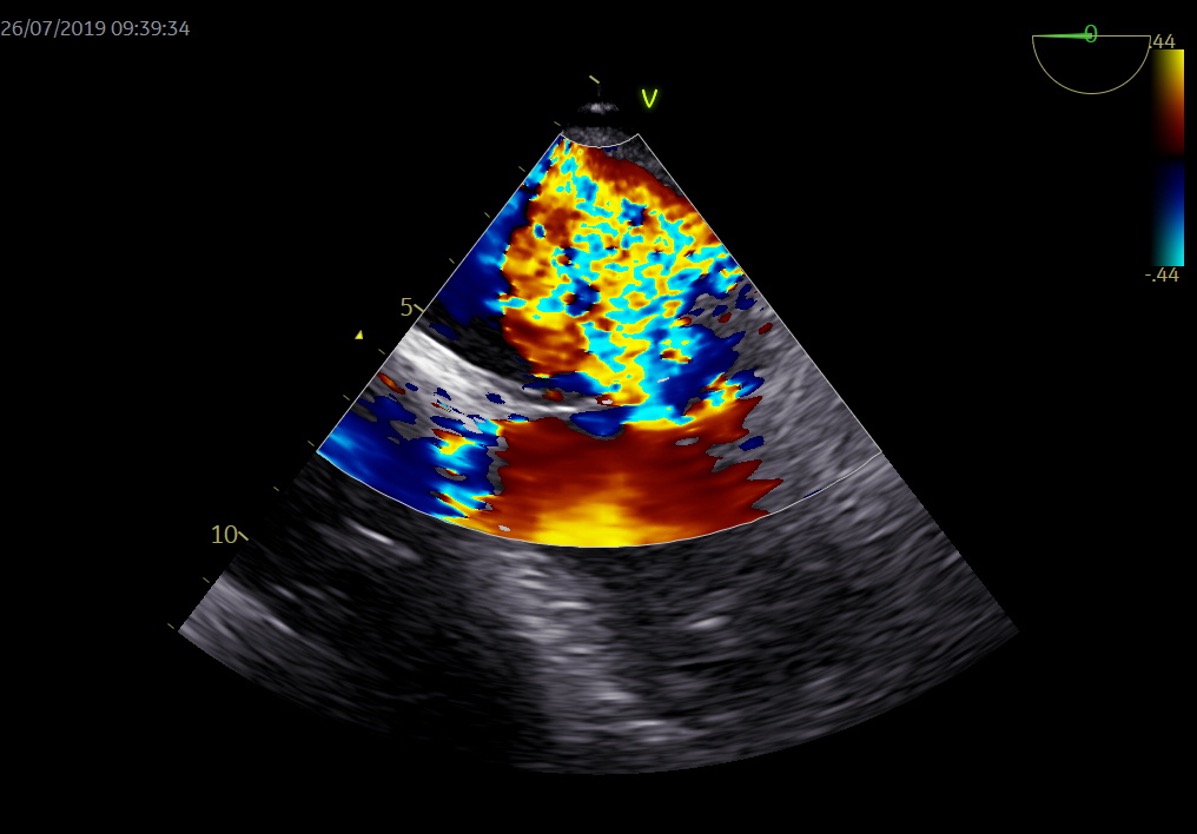 Figura 4. IM severa modo Doppler color.