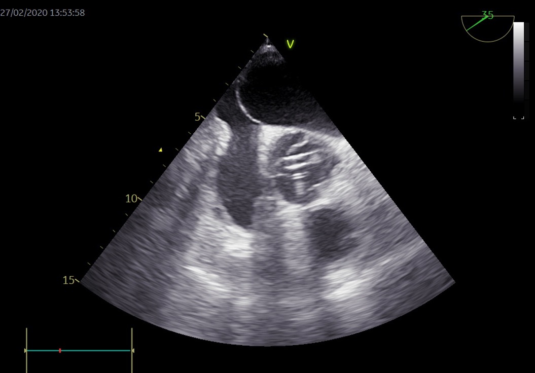 Figura 6. Impella en válvula aórtica.