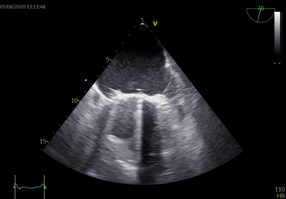 Figura 7. Prótesis mitral y orejuela AI.