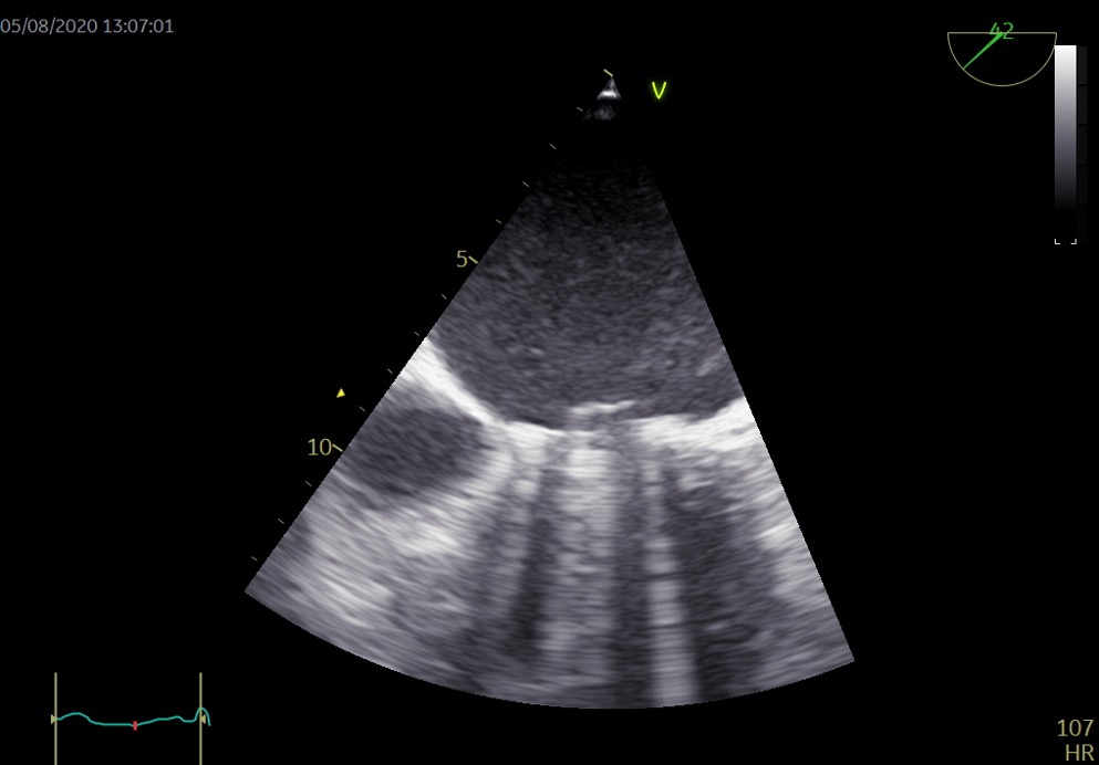Figura 8. Prótesis mitral.