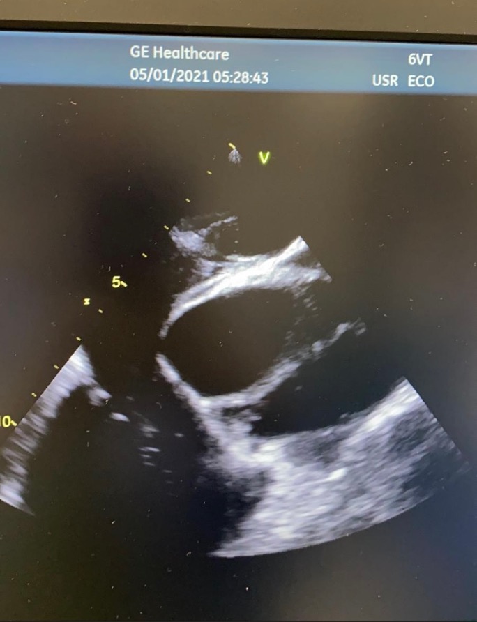 Figura 9. Disección de aorta.