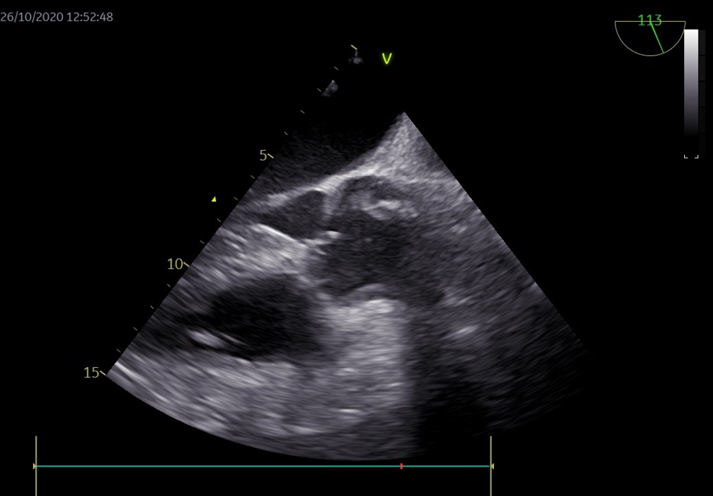 Figura 10. Redisección de aorta.