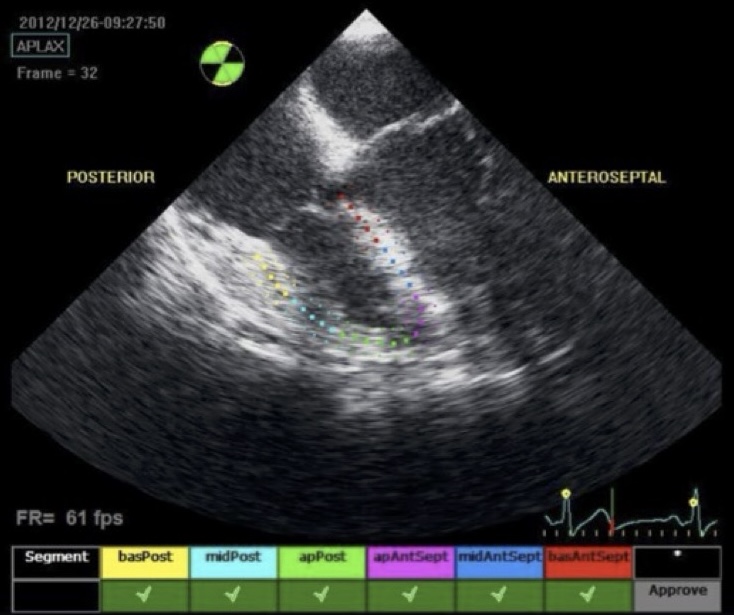 Figura 3. Speckle-tracking strain de VD. La zona de interés se traza manualmente por el borde endocárdico. Los números del dibujo representan los valores del pico sistólico del strain segmentario y global. SLG de VD mide -27%.