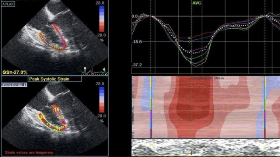 Figura 3. Speckle-tracking strain de VD. La zona de interés se traza manualmente por el borde endocárdico. Los números del dibujo representan los valores del pico sistólico del strain segmentario y global. SLG de VD mide -27%.