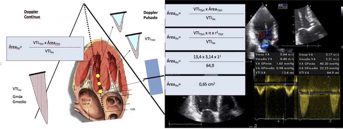 Figura 2: Ejemplo estimación AVA: VTITSVI: Integral Velocidad TSVI estimada por Doppler pulsado en TSVI; VTIAo: Integral velocidad máxima estimada por doppler continuo.