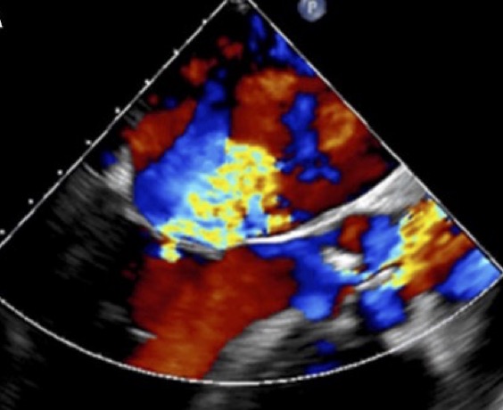 Figura 1. ETE con Doppler color, plano de tres cámaras. Se muestra la estenosis aórtica e insuficiencia mitral severa concomitante. Figura 1. ETE con Doppler color, plano de tres cámaras. Se muestra la estenosis aórtica e insuficiencia mitral severa concomitante.