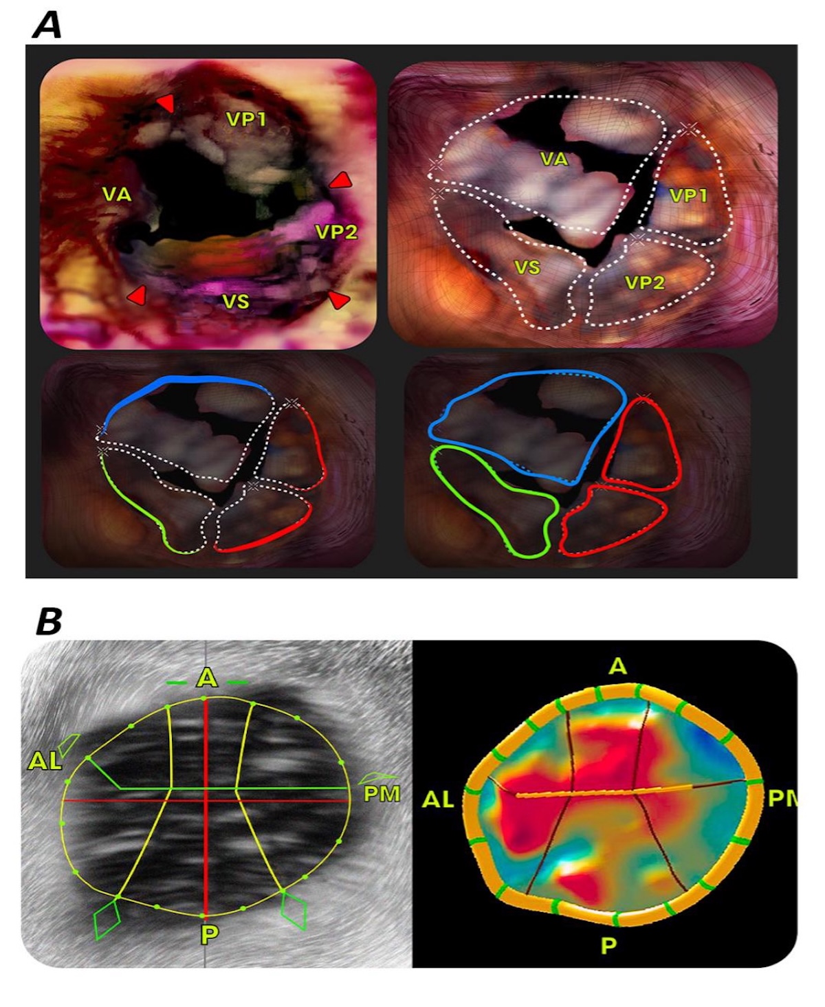 Figura 1: Determinación y medición del número de valvas mediante imágenes tridimensionales. (A) Trazado y medición de cada valva. (B) las distancias anterior y posterior y anterolateral y posteromedial se determinaron mediante el MVN/3D. Las puntas de flecha indican la comisura. A: anterior; AL: anterolateral; VA: velo anterior, PM: posteromedial; VP1 y VP2: velos posteriores; VS: velo septal. Imagen de diseño gráfico tridimensional realizada en base a figura 1 de Kawase,T. et al 2022. (TFM 2024 Dr. guerrero J.)