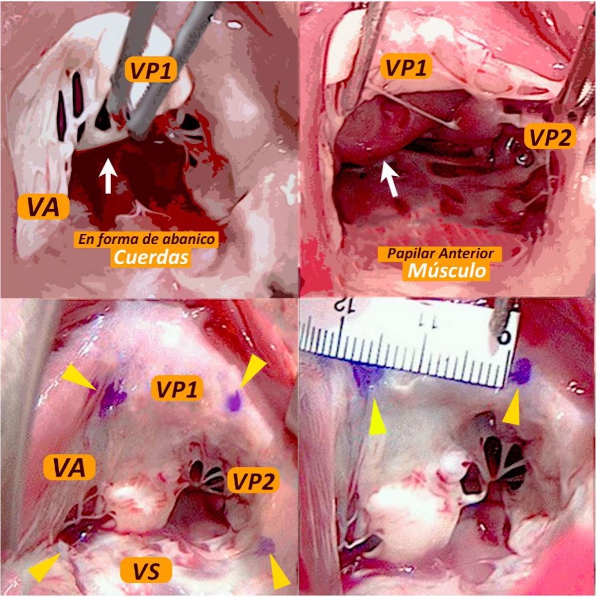 Figura 2. Hallazgos intraoperatorios de VT con dos valvas posteriores. La cabeza de flecha indica la comisura . VA; valva anterior , VP1: valva posterior 1, VP2:valva posterior 2. VS;valva septal. Imagen de diseño gráfico realizada en base a figura 2 de Kawase,T. et al.2022. (TFM 2024 Dr. guerrero J.) Figura 2. Hallazgos intraoperatorios de VT con dos valvas posteriores. La cabeza de flecha indica la comisura . VA; valva anterior , VP1: valva posterior 1, VP2:valva posterior 2. VS;valva septal. Imagen de diseño gráfico realizada en base a figura 2 de Kawase,T. et al.2022. (TFM 2024 Dr. guerrero J.)