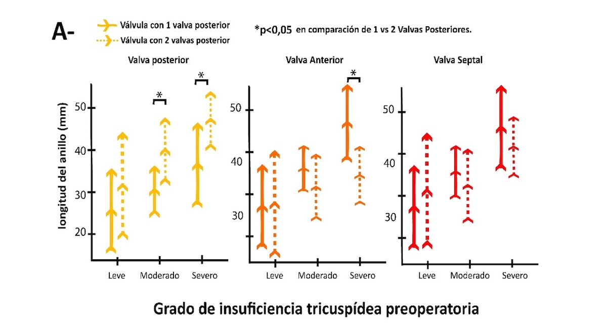 Figura 4: (A) Comparación de longitud del anillo de cada valva entre válvulas con una y dos valvas posteriores por grado de Regurgitacion Tricuspidea. Imagen de diseño gráfico realizada en base a figura 5A de Kawase,T. et al. (TFM 2024 Dr. guerrero J.) Figura 4: (A) Comparación de longitud del anillo de cada valva entre válvulas con una y dos valvas posteriores por grado de Regurgitacion Tricuspidea. Imagen de diseño gráfico realizada en base a figura 5A de Kawase,T. et al. (TFM 2024 Dr. guerrero J.)
