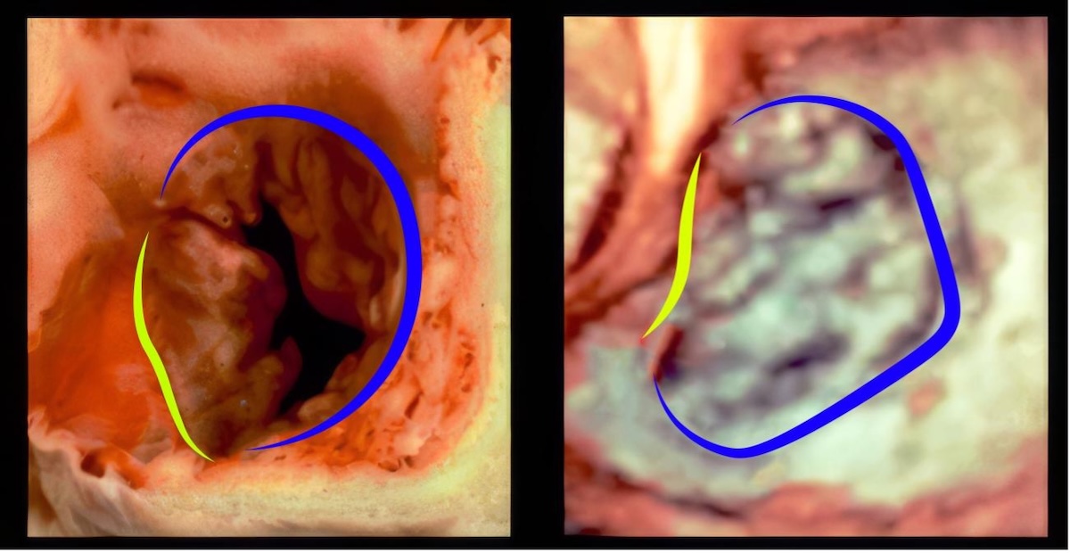Figura 7. (A y B) la forma oval del anillo Tricuspídeo. (A) espécimen anatómico (B) correspondiente imagen de ETE 3D. la línea Azul marca el anillo mural y la Amarilla el anillo septal. Imagen de diseño gráfico realizada en base a figura 2 de Schlossbauer,S. et al. 2021. (TFM 2024 Dr.guerrero J. ) Figura 7. (A y B) la forma oval del anillo Tricuspídeo. (A) espécimen anatómico (B) correspondiente imagen de ETE 3D. la línea Azul marca el anillo mural y la Amarilla el anillo septal. Imagen de diseño gráfico realizada en base a figura 2 de Schlossbauer,S. et al. 2021. (TFM 2024 Dr.guerrero J. )