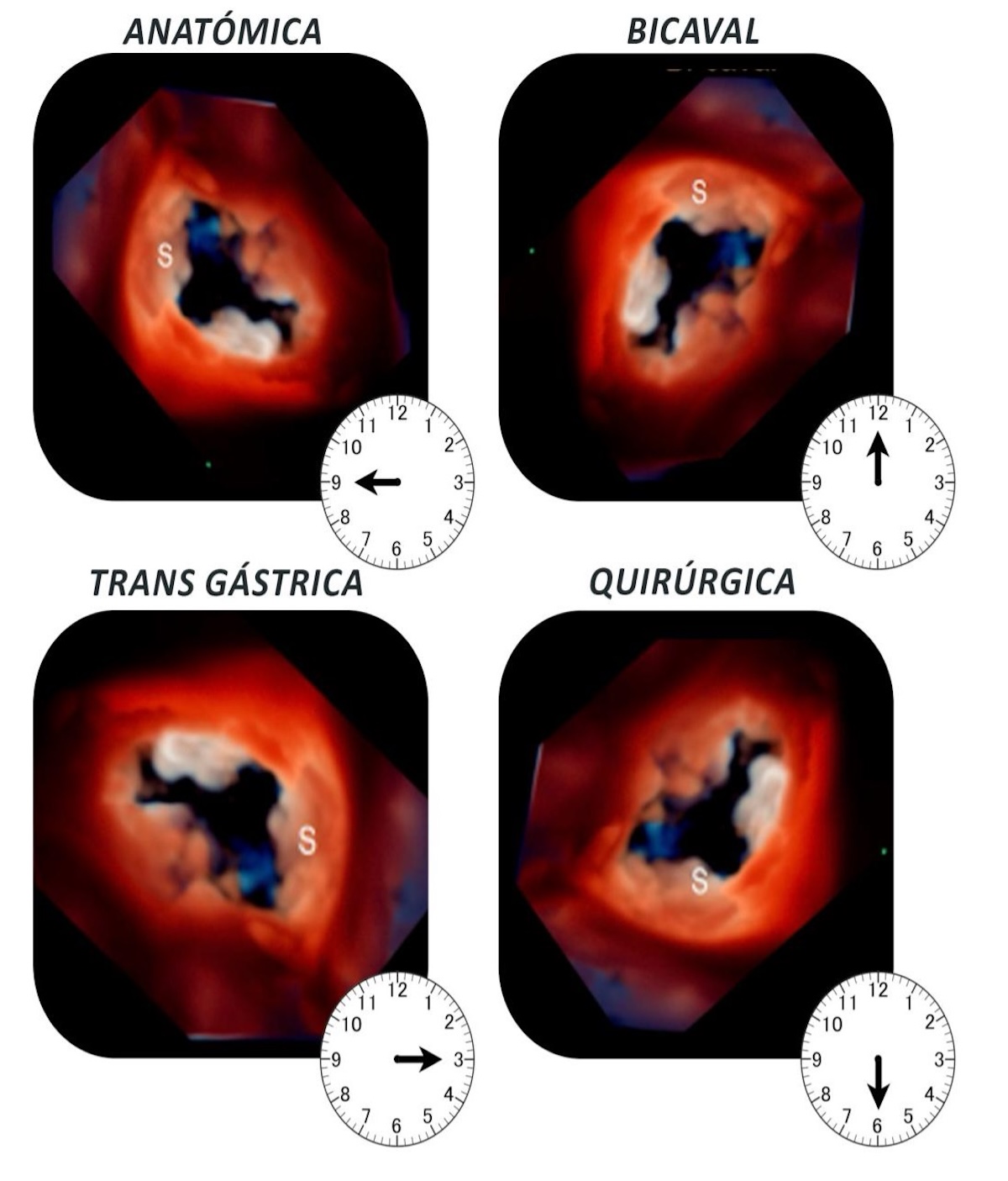 Figura 8. Las 4 vistas clásicas ¨ in face¨ de la válvula Tricúspide Imagen de diseño gráfico realizada en base a figura 1. de Schlossbauer,S. et al. 2021. (TFM 2024 Dr. Guerrero J. ) Figura 8. Las 4 vistas clásicas ¨ in face¨ de la válvula Tricúspide Imagen de diseño gráfico realizada en base a figura 1. de Schlossbauer,S. et al. 2021. (TFM 2024 Dr. Guerrero J. )