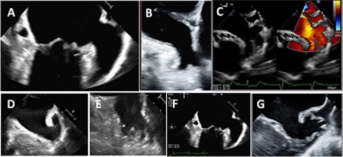 Figura 2: El panel superior muestra ejemplos de ecocardiografía transesofágica bidimensional del lóbulo de la orejuela auricular izquierda A) Unilobulado b) Bilobulado y C) trilobulado con flujo Doppler en su interior. El panel inferior muestra diferentes morfologías de orejuela izquierda D) Ala de pollo E) Cactus F) Manga de Viento y G) Coliflor.1