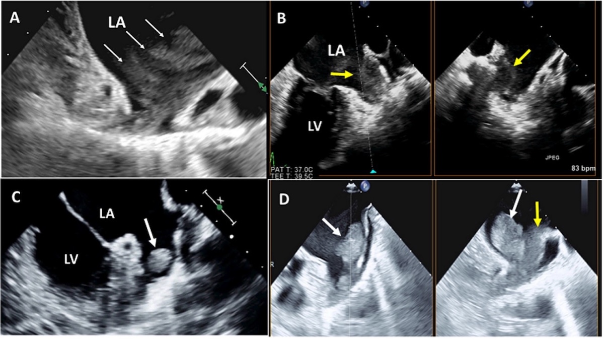 Figura 3: La visualización de la orejuela auricular izquierda (OAI) mediante ecocardiografía transesofágica bidimensional muestra la secuela de estasis sanguínea. A Contraste ecográfico espontáneo intenso (flechas blancas pequeñas). B La vista en el plano X de la OAI muestra un contraste ecográfico espontáneo denso asociado con la formación de lodo (flecha amarilla). C Trombo pequeño y redondeado en la OAI (flecha blanca). D Trombo grande en la OAI que sobresale hacia la OAI (flechas blancas) asociado con lodo (flecha amarilla)1