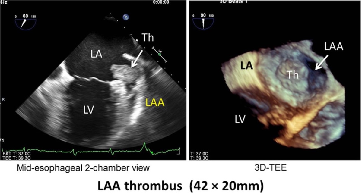 Figura 5. Ecocardiografía transesofágica (ETE) de la aurícula izquierda. La ETE confirmó la presencia de un gran trombo móvil (42 × 20 mm) en la orejuela auricular izquierda (OAI). La ETE tridimensional en tiempo real proporcionó una vista frontal de la OAI, que mostró claramente el trombo en forma de bola oscilante en la OAI. OAI indica aurícula izquierda; VI, ventrículo izquierdo; y Th, trombo.1 Figura 5. Ecocardiografía transesofágica (ETE) de la aurícula izquierda. La ETE confirmó la presencia de un gran trombo móvil (42 × 20 mm) en la orejuela auricular izquierda (OAI). La ETE tridimensional en tiempo real proporcionó una vista frontal de la OAI, que mostró claramente el trombo en forma de bola oscilante en la OAI. OAI indica aurícula izquierda; VI, ventrículo izquierdo; y Th, trombo.1